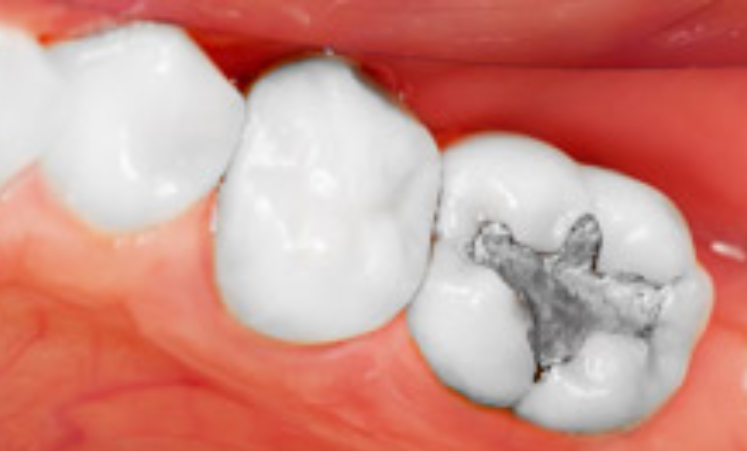 Composite Fillings in Coral Springs Image