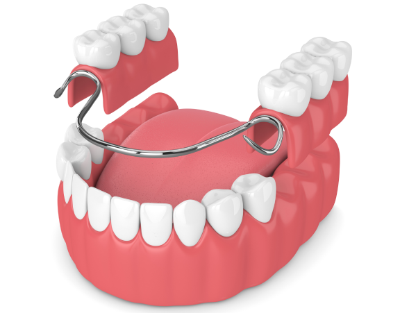 Removable Dentures in Coral Springs Image