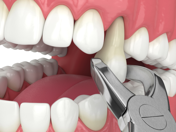 Tooth Extractions in Coral Springs Image