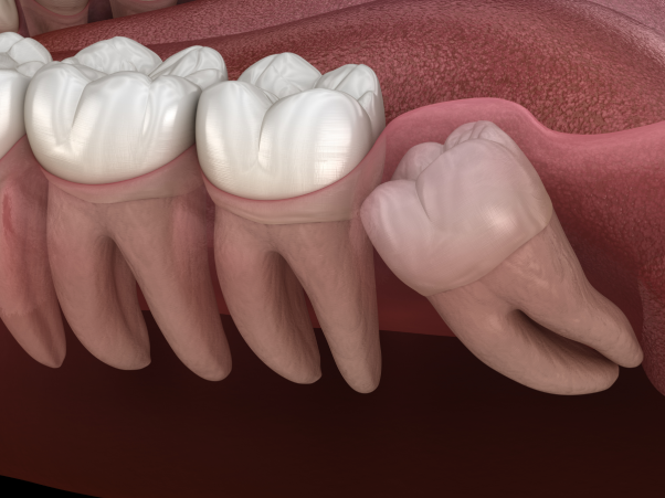 Wisdom Tooth Extraction in Coral Springs Image