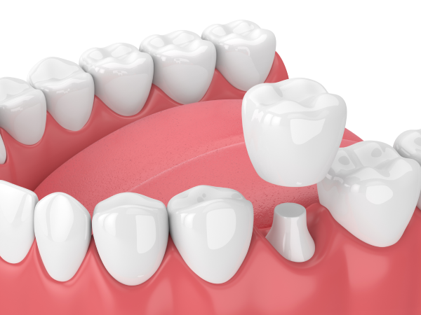 Tooth Extractions in Coral Springs Image