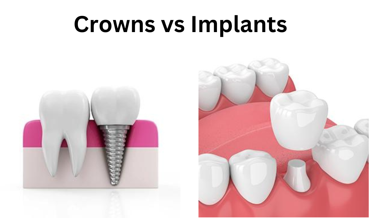 Crowns vs Implants