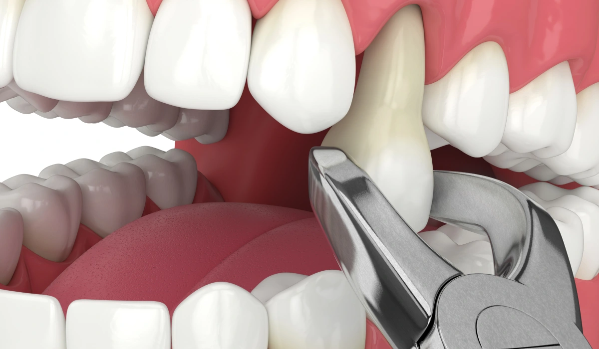 DO'S & DON'TS AFTER TOOTH EXTRACTION