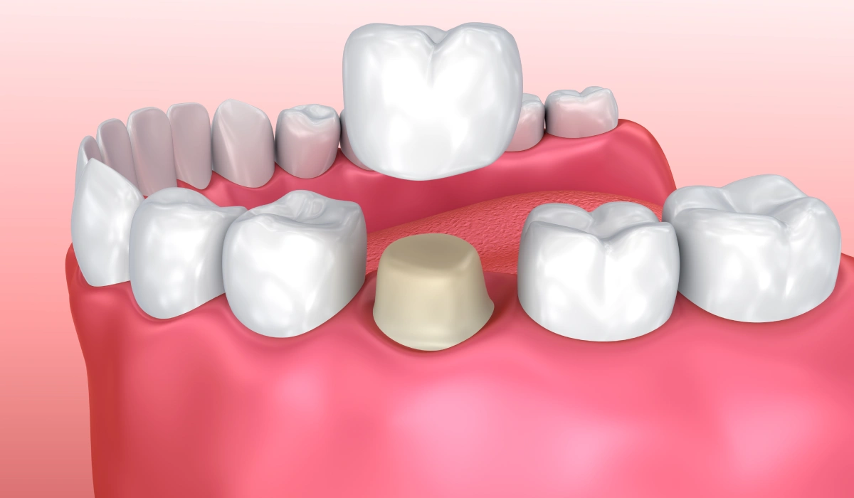 How Long Do Dental Crown Last