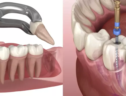 Root Canal Vs Tooth Extraction: Which is better