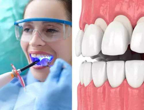Dental Bonding Vs Veneers – Pros And Cons of Each