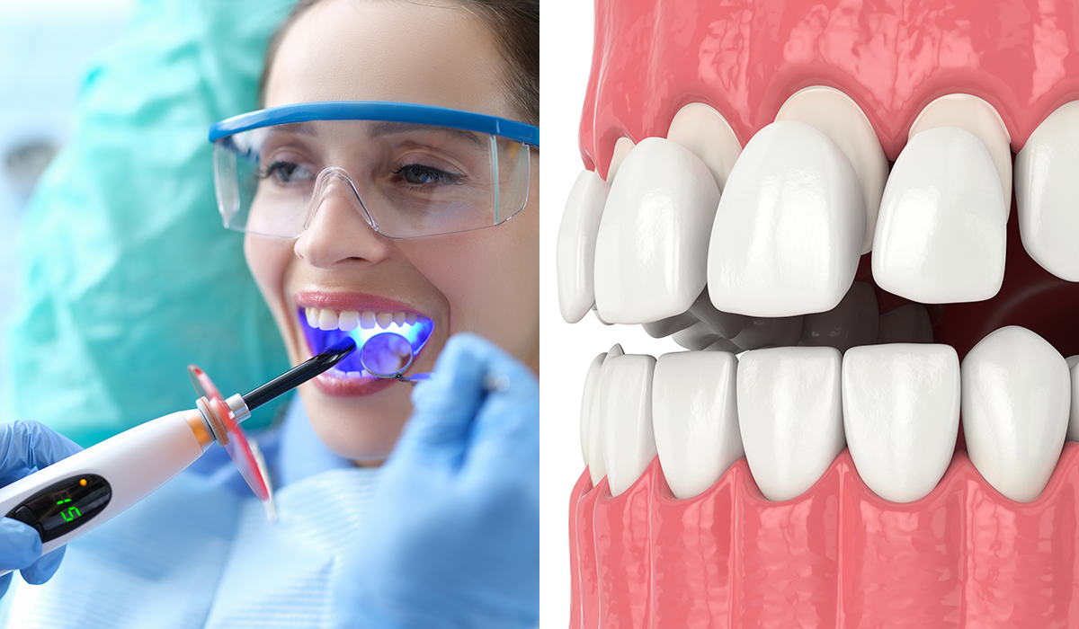 Dental Bonding Vs Veneers- 1