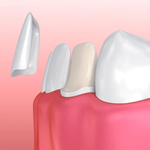 Dental Bonding Vs Veneers