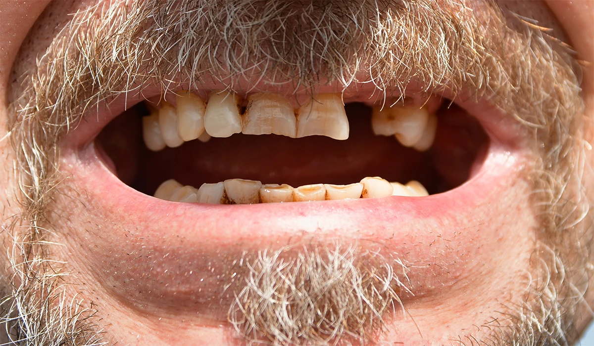 Dental Implants For Missing Teeth