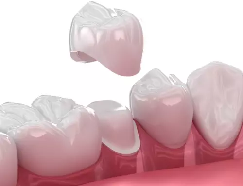 Dental Crown Procedure: A Step-By-Step Guide